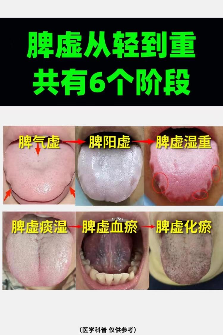 脾虚从轻到重，一共有6个阶段，潘大夫教你辨别
1、脾气虚
表现：舌中凹陷，舌软无