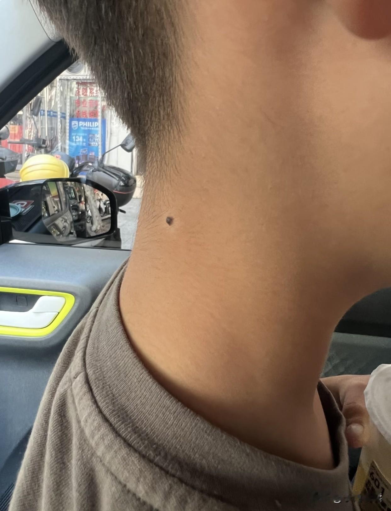 不知道为什么，突然发现儿子身后出现了两处白斑，连一颗痣都被白斑包围了。有人知道这