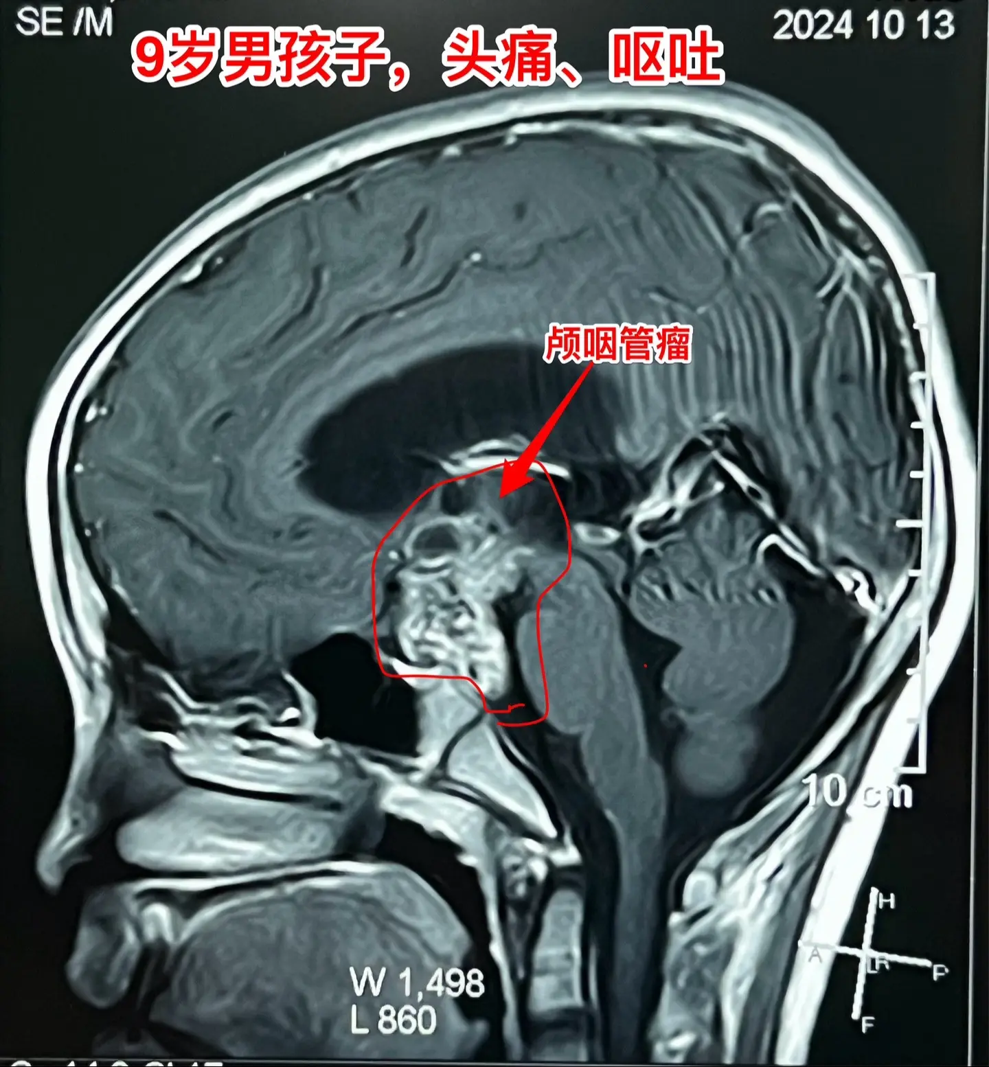 今日两个颅咽管瘤手术。1，6岁男孩子，安徽宿州人。2023年5月因视力...