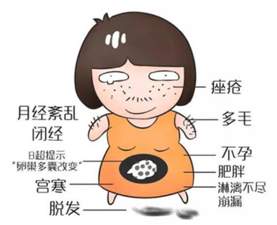 月经不调、长痘痘、瘦不下来，可能是多囊找上门了
很多20～30岁女生都有类似烦恼