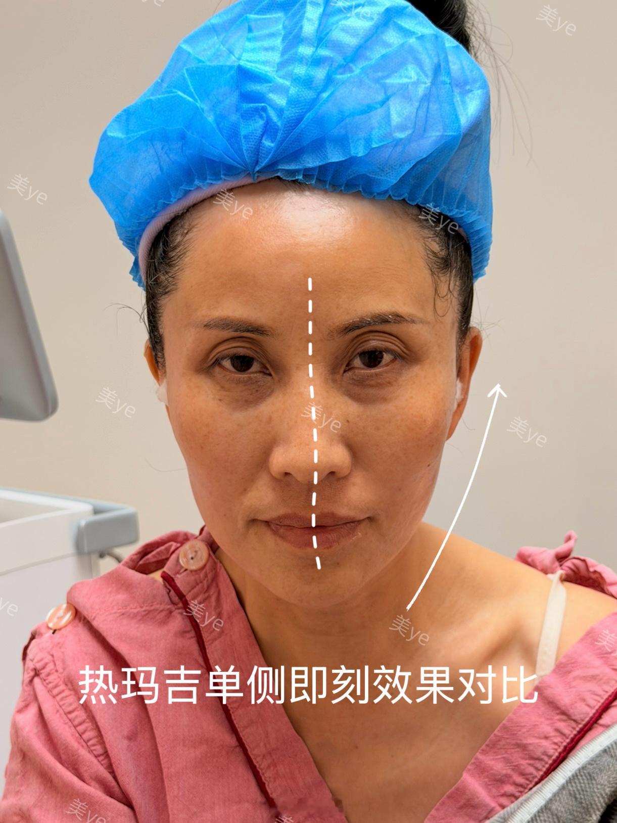 热玛吉对苹果肌的提升和压实效果是即刻可见的法令纹也会跟着一起变浅我妈妈这种已经没