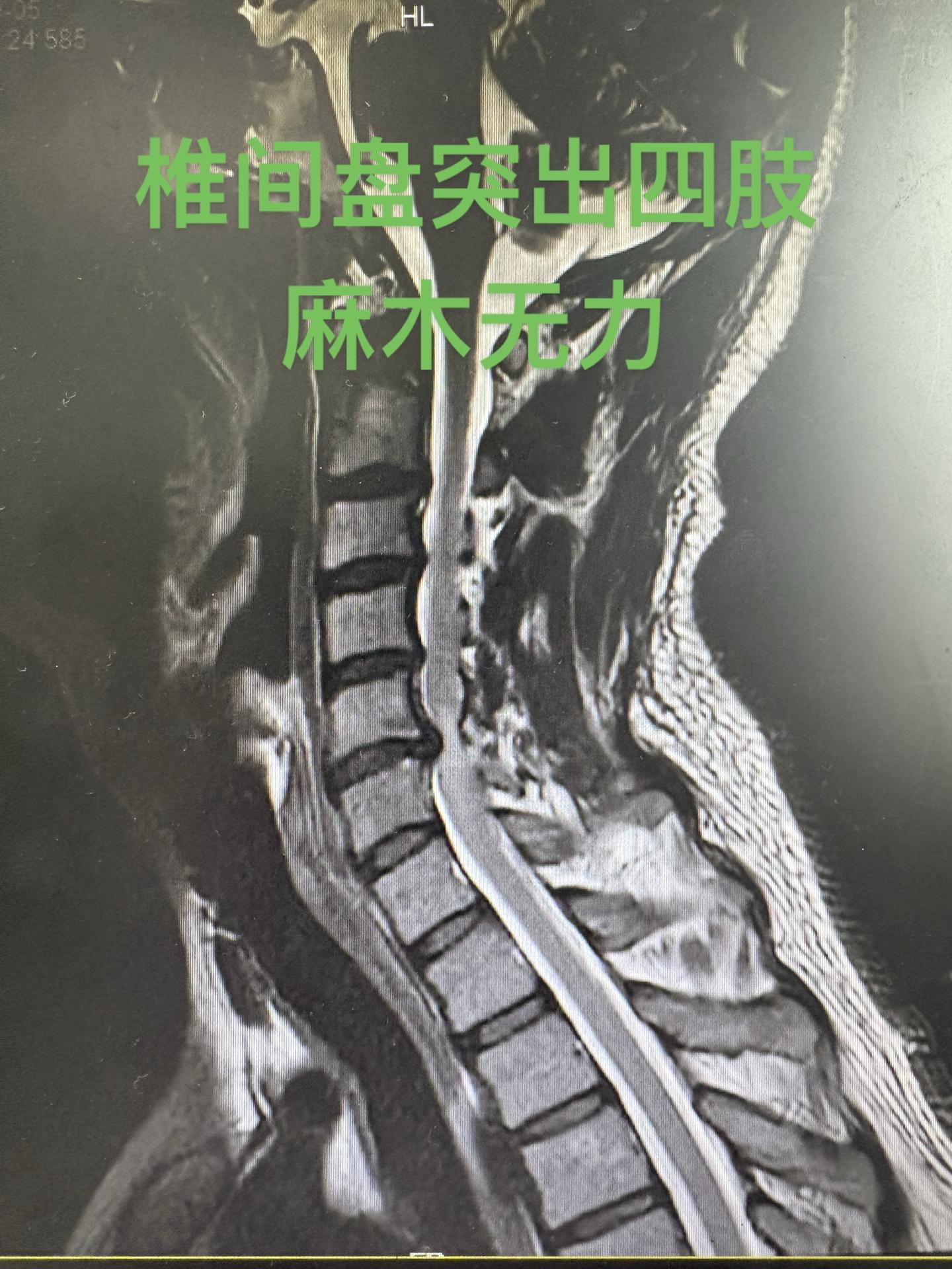 脊髓型颈椎病。 典型症状：四肢麻木，行走像踩在棉花上。持筷夹物易落。手...