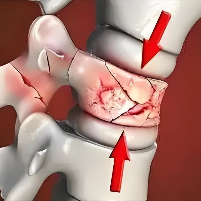 脊髓损伤恢复，只要熬到第三阶段，恭喜你，离正常生活不远了

很多脊髓损伤的朋友和