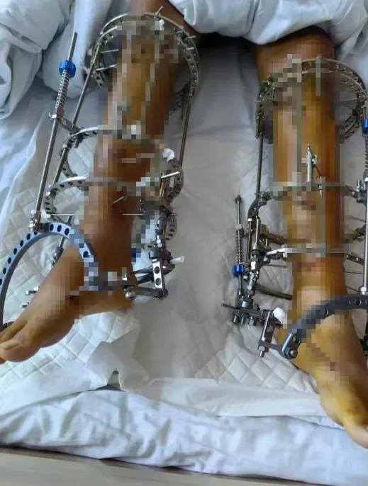 花60万断骨增高，换来的却是X型腿和终身疼痛！

这几位年轻人的血泪经历曝光后，