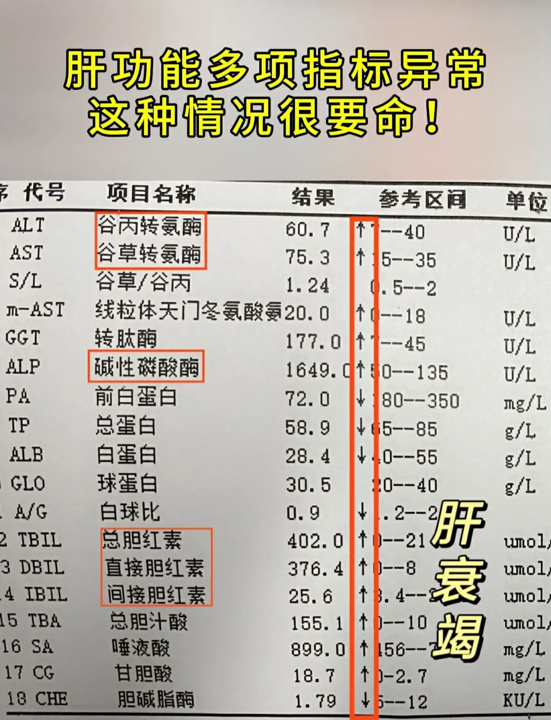 这是一位山东肝衰竭患者的化验单，这位患者有40多年乙肝没抗过病毒，常年...