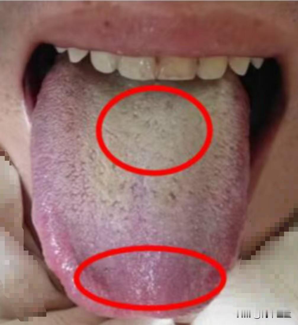 这个小伙子，年纪不大，身体问题却很多，像这样的舌象，真的不建议你滋阴
主诉：失眠