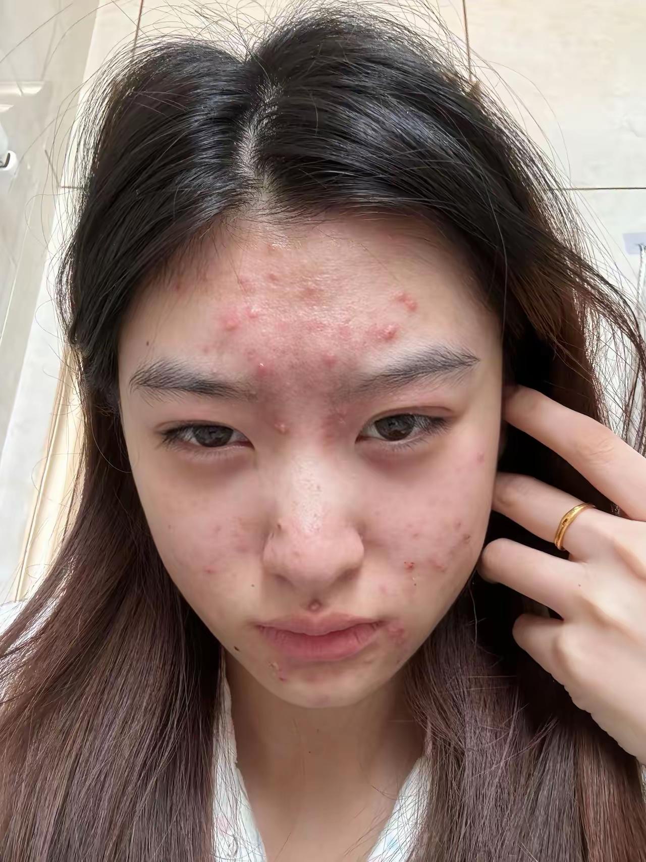 内分泌太旺盛了，
这可咋整啊，
满脸都是痘，
有知道咋整的么？