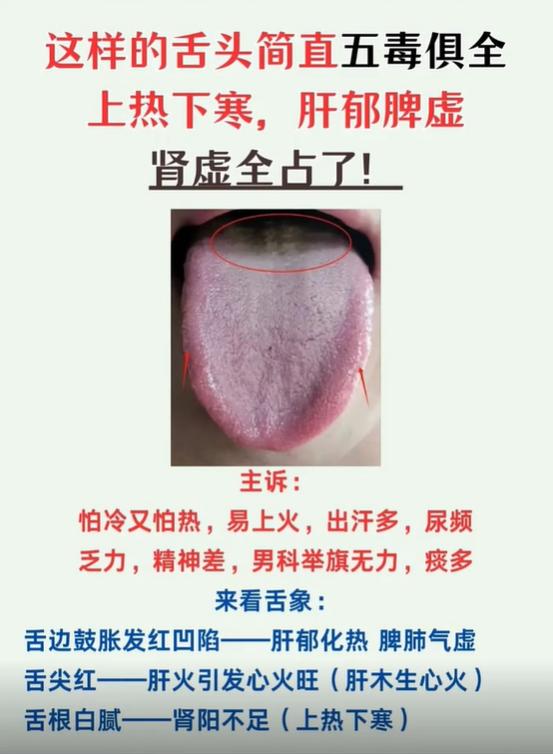 上热下寒的舌象，往往同时伴随肝郁、脾虚、肾虚
