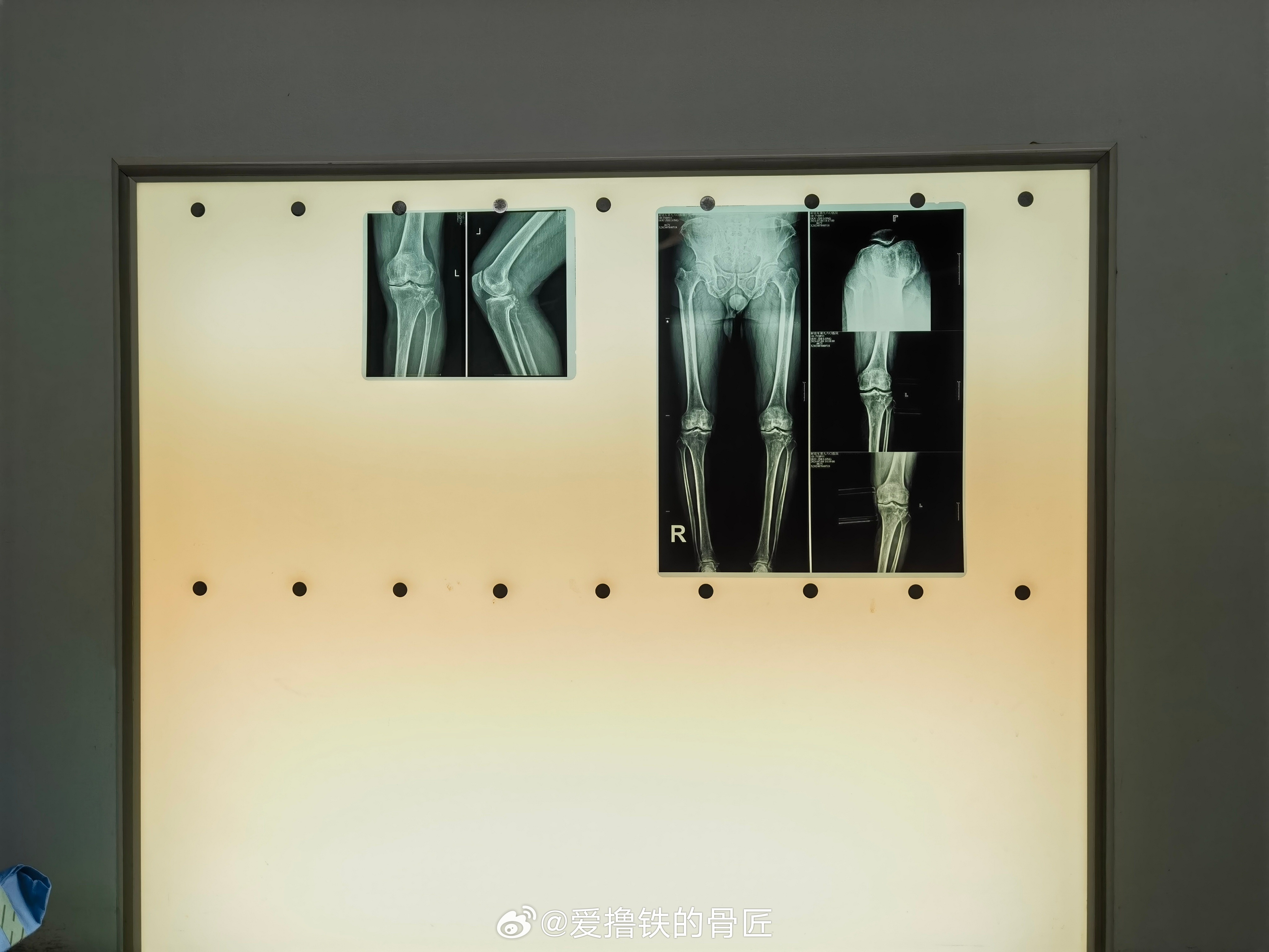 大叔麻醉醒了第一句话，几点了？麻醉医生：大叔，11点了该起床了…… ​​​