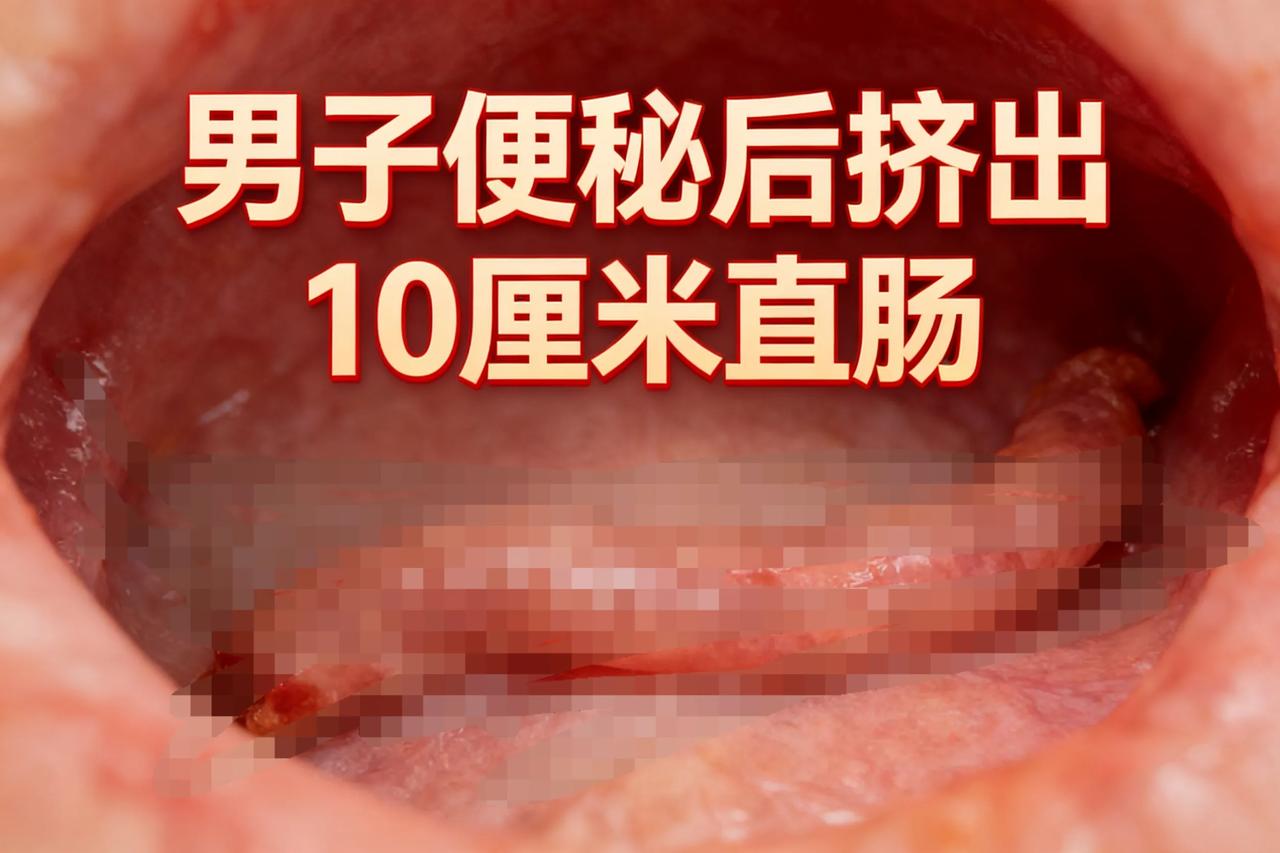 太吓人！便秘的注意了！别再硬憋硬使劲了！
福建一男子春节后因重油饮食，再加上久坐