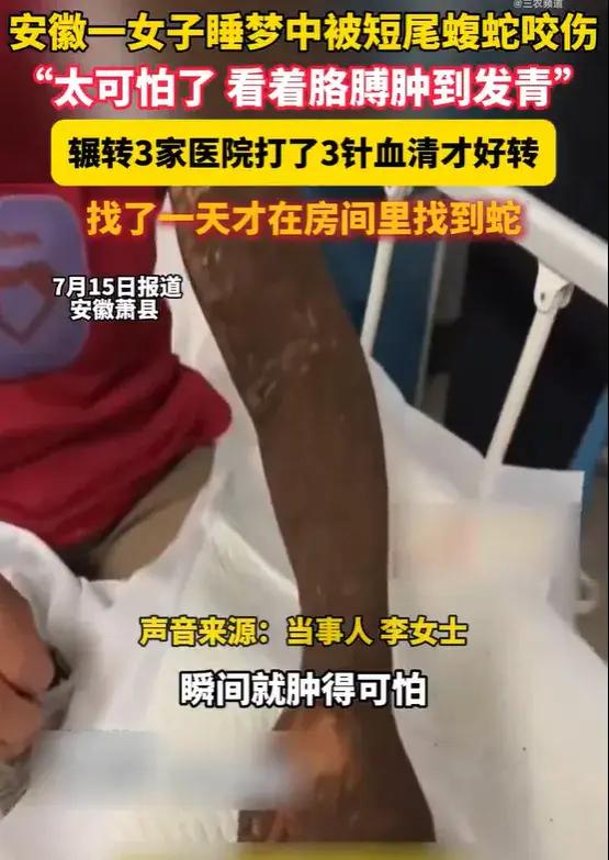 7月17日报道，安徽，一女子熟睡时，被一阵刺痛惊醒，她发现胳膊有两个小窟窿眼，然