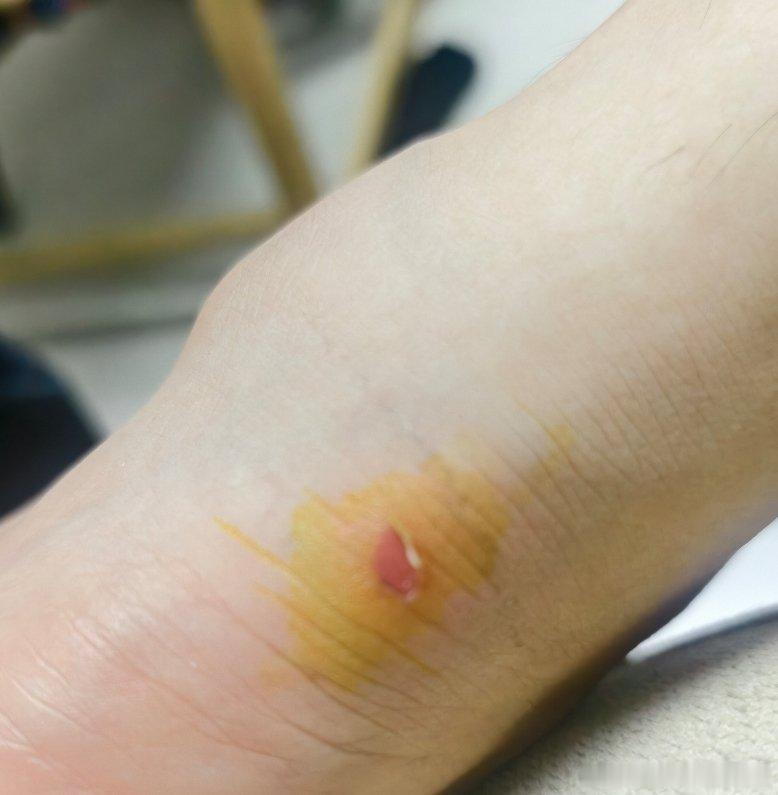 昨天也是der忘了换袜子穿船袜跑的八公里磨破皮了还在那跑呢痧挺疼啊 