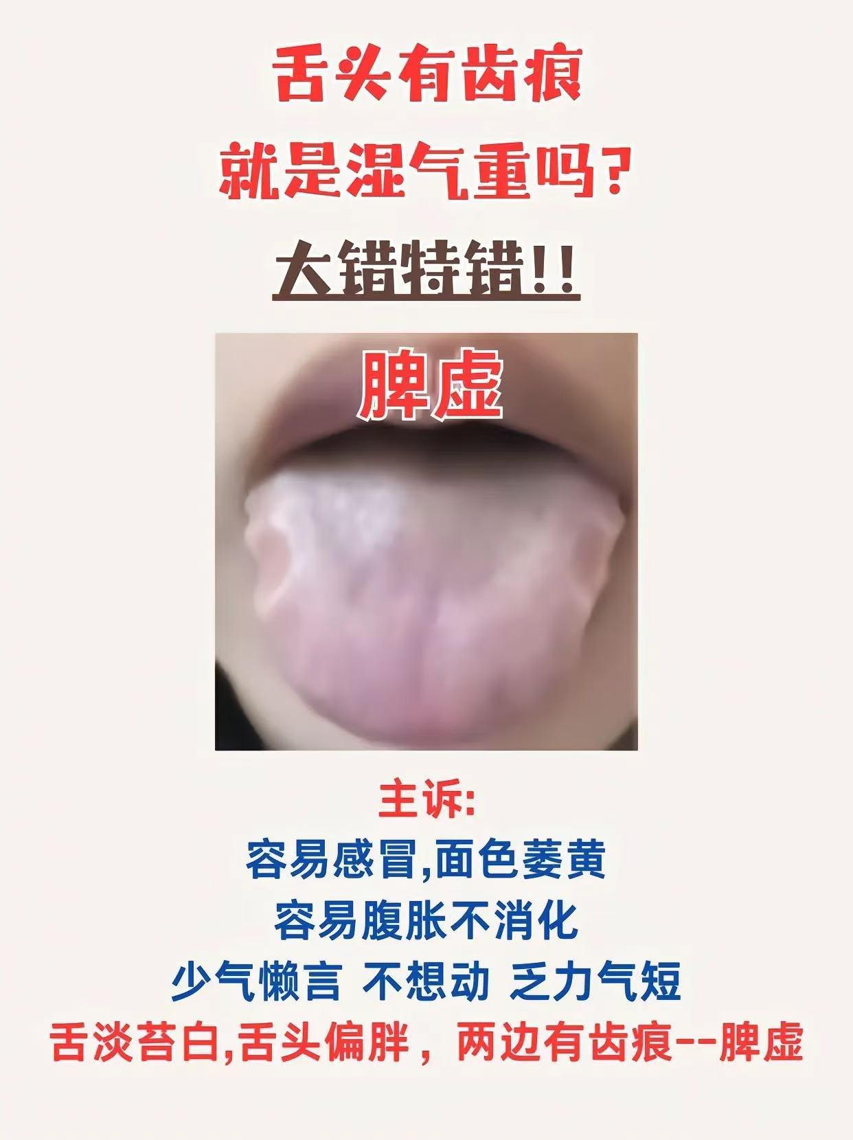 舌头有齿痕就是混气重吗?大错特错!!