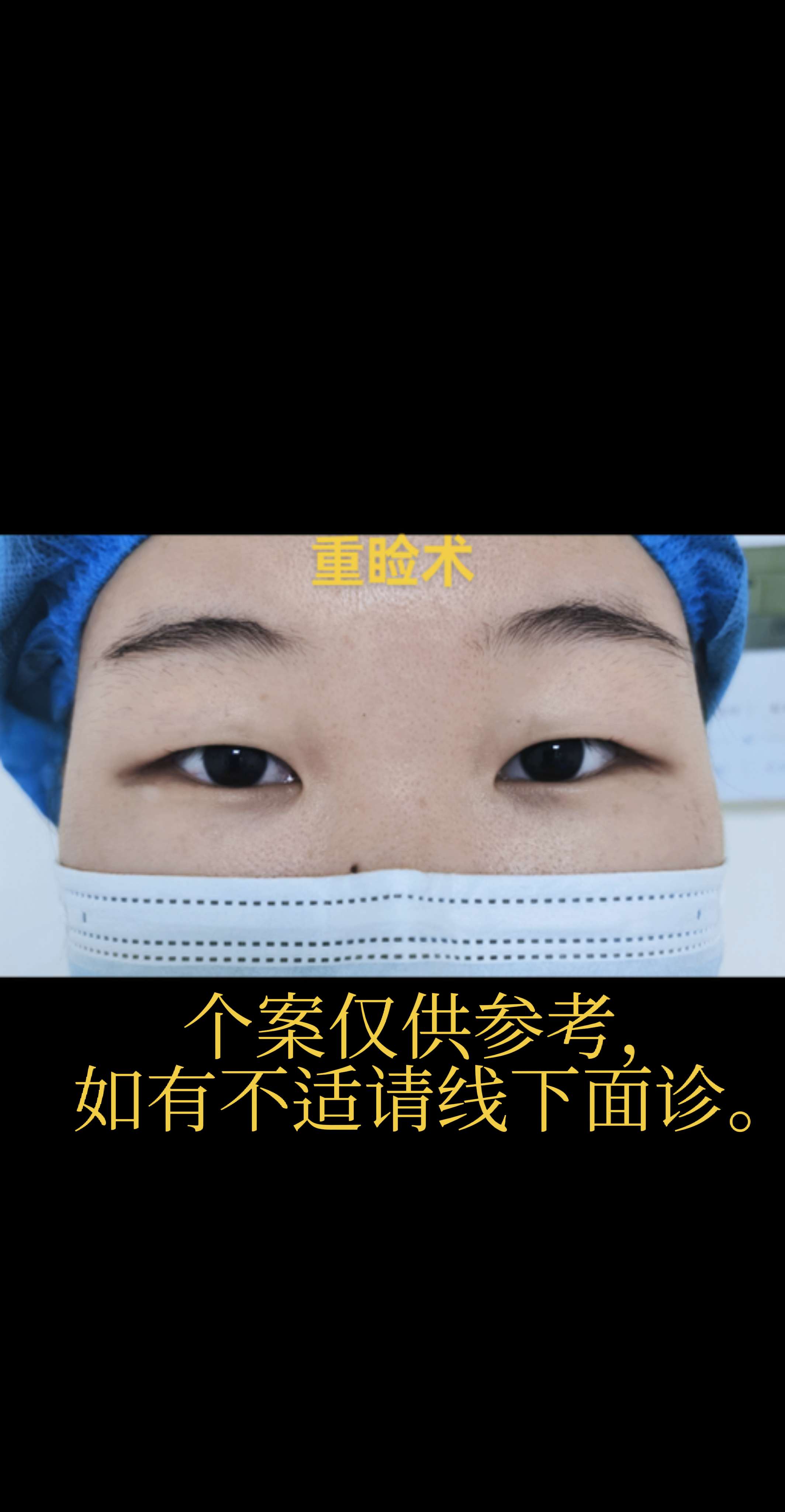 上睑下垂手术。