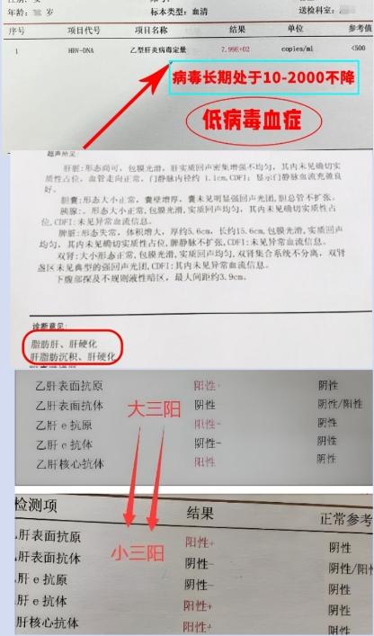 乙肝抗病毒不注意这几点，很容易肝硬化！     从医近30年，在临床上...