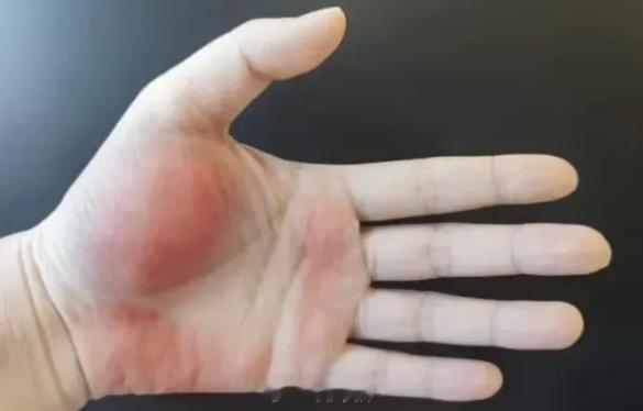 【肝脏预警信号一黄二红三黑】身上出现一黄二红三黑要查肝 肝脏很能“忍”，有时候明
