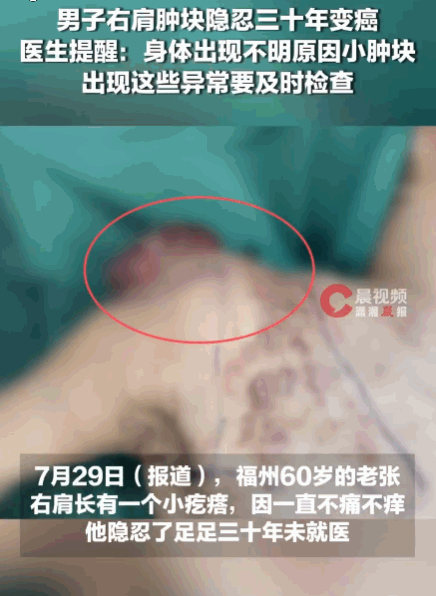 小病不防，大病要命！福州，一60岁大爷，30年前右肩长了个小疙瘩，因不疼不痒便听
