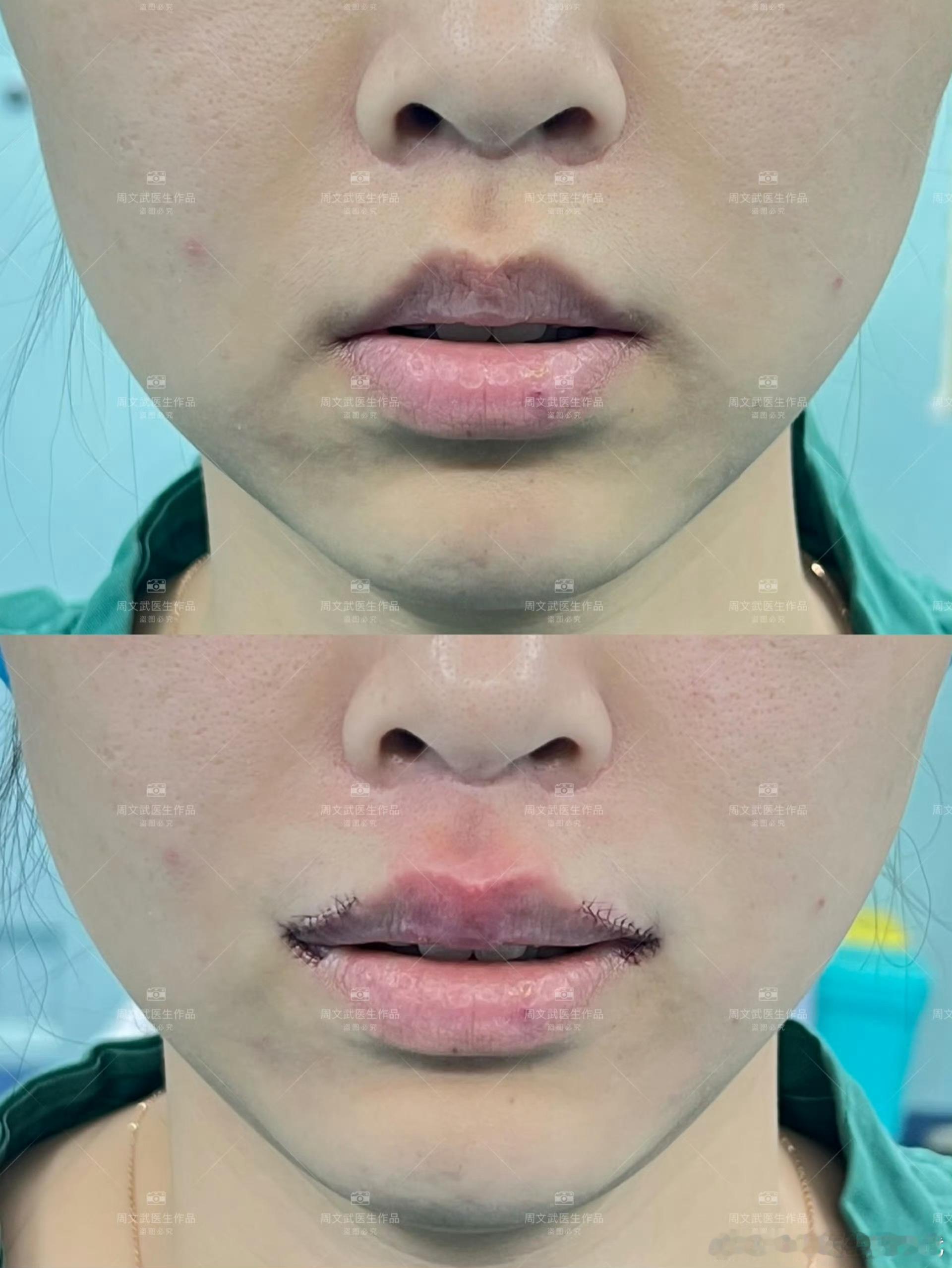 我就是嘴角红唇内卷所以想做这个手术，我这还是打了玻尿酸的，不打的话会更卷。但现在