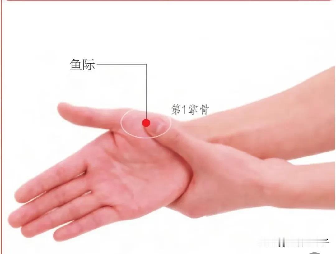 【典型病例3】鱼际穴治疗哮喘
患者诉支气管哮喘反复发作1年余，此次发作3天。就诊