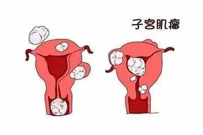 #健康真探社#【子宫肌瘤这个时候快速增大要重视！】子宫肌瘤通常是一种常见的良性肿