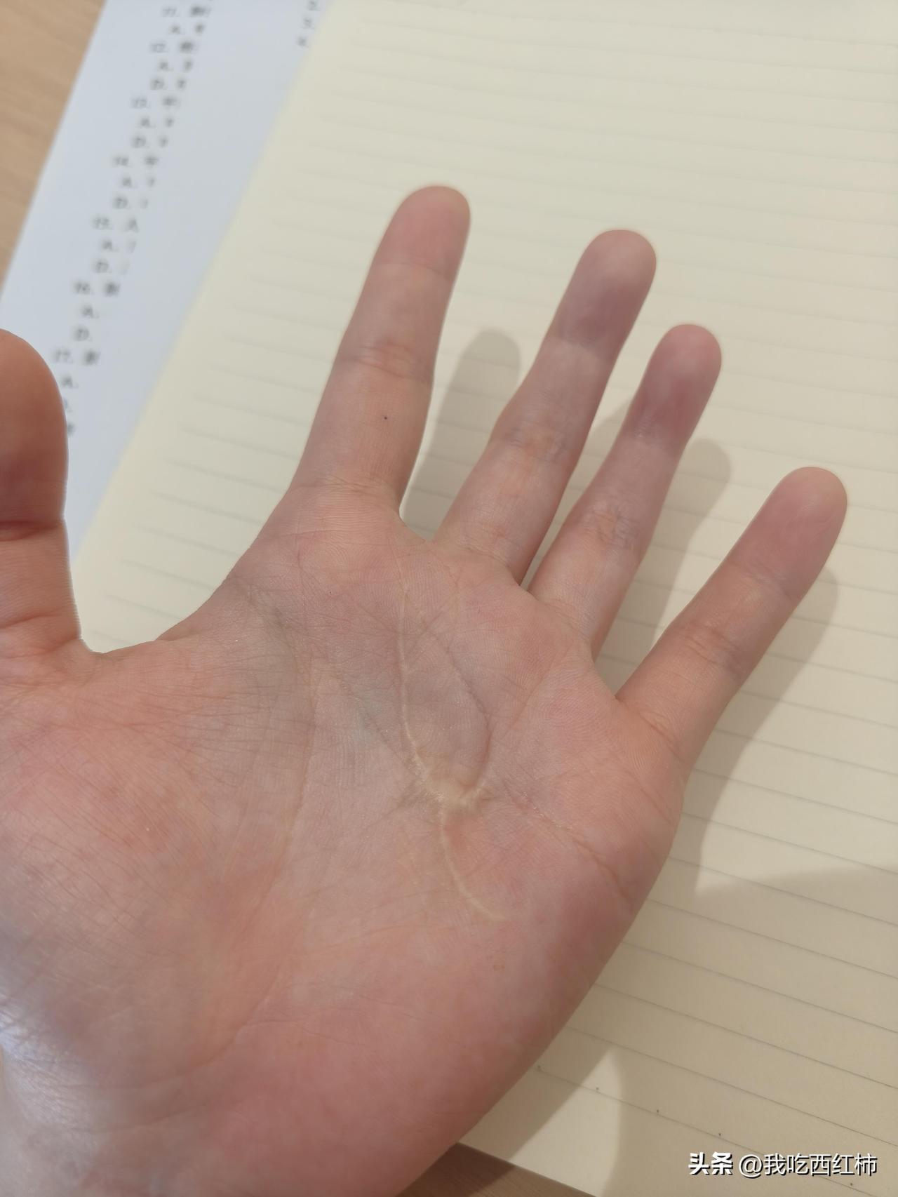 在我小学的时候不小心被玻璃杯子划伤了手掌，当时流了好多血，害怕缝针所以去了中医那