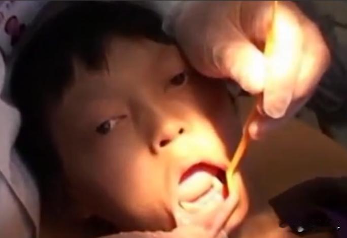 这还是人吗？重庆15岁男孩长了一对獠牙，从小就惧怕阳光，医生检查后也被吓了一跳。