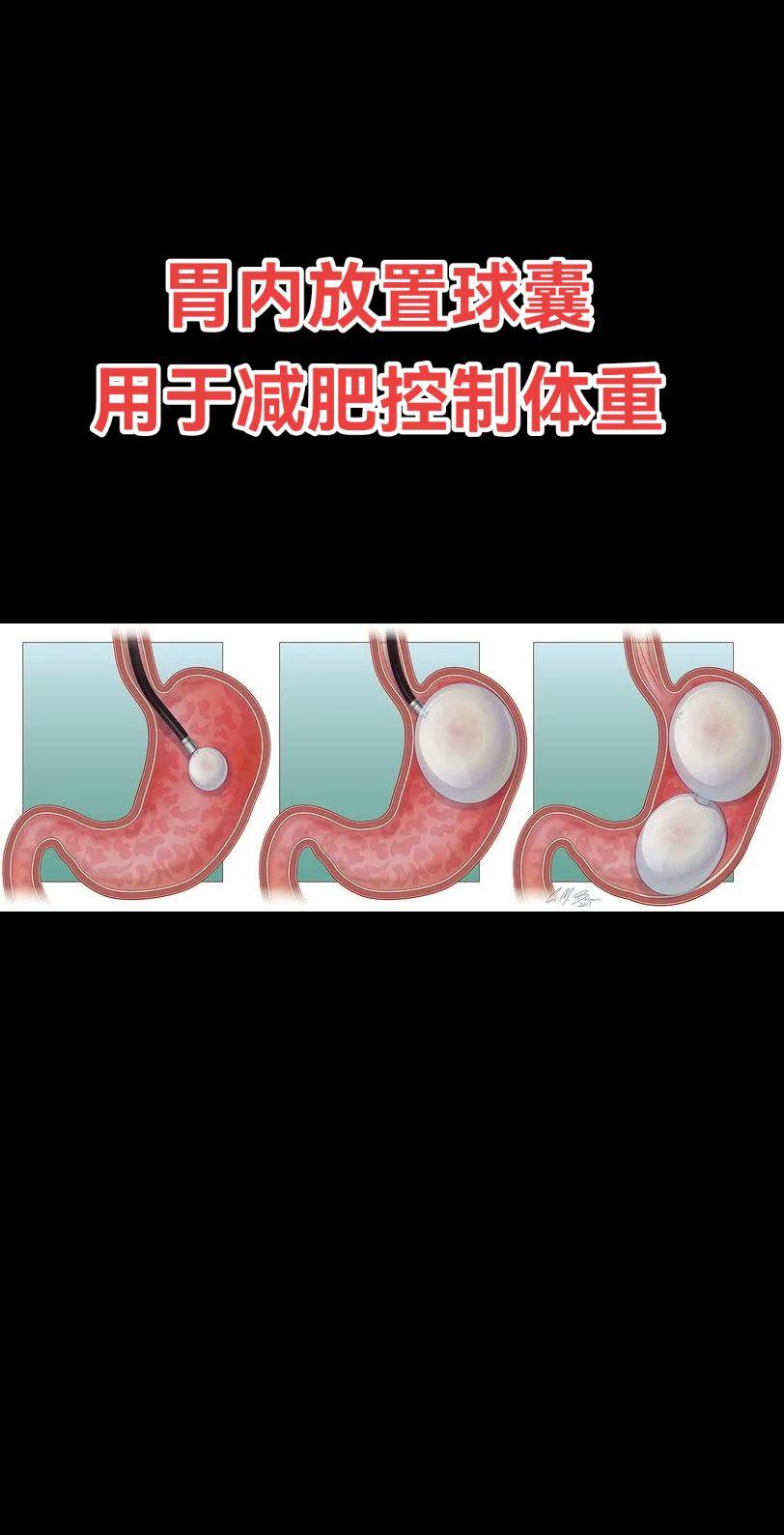 减肥。国外开展，国内正在试着开展。