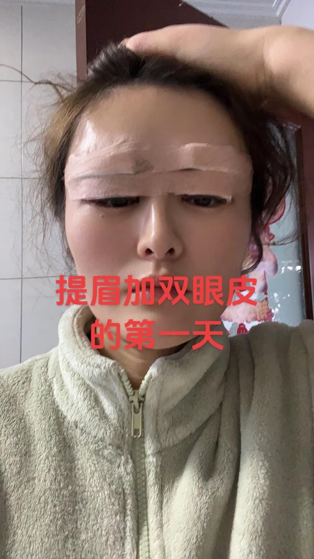 要想美先变鬼，肿是真肿，疼是真疼，希望越来越自然吧