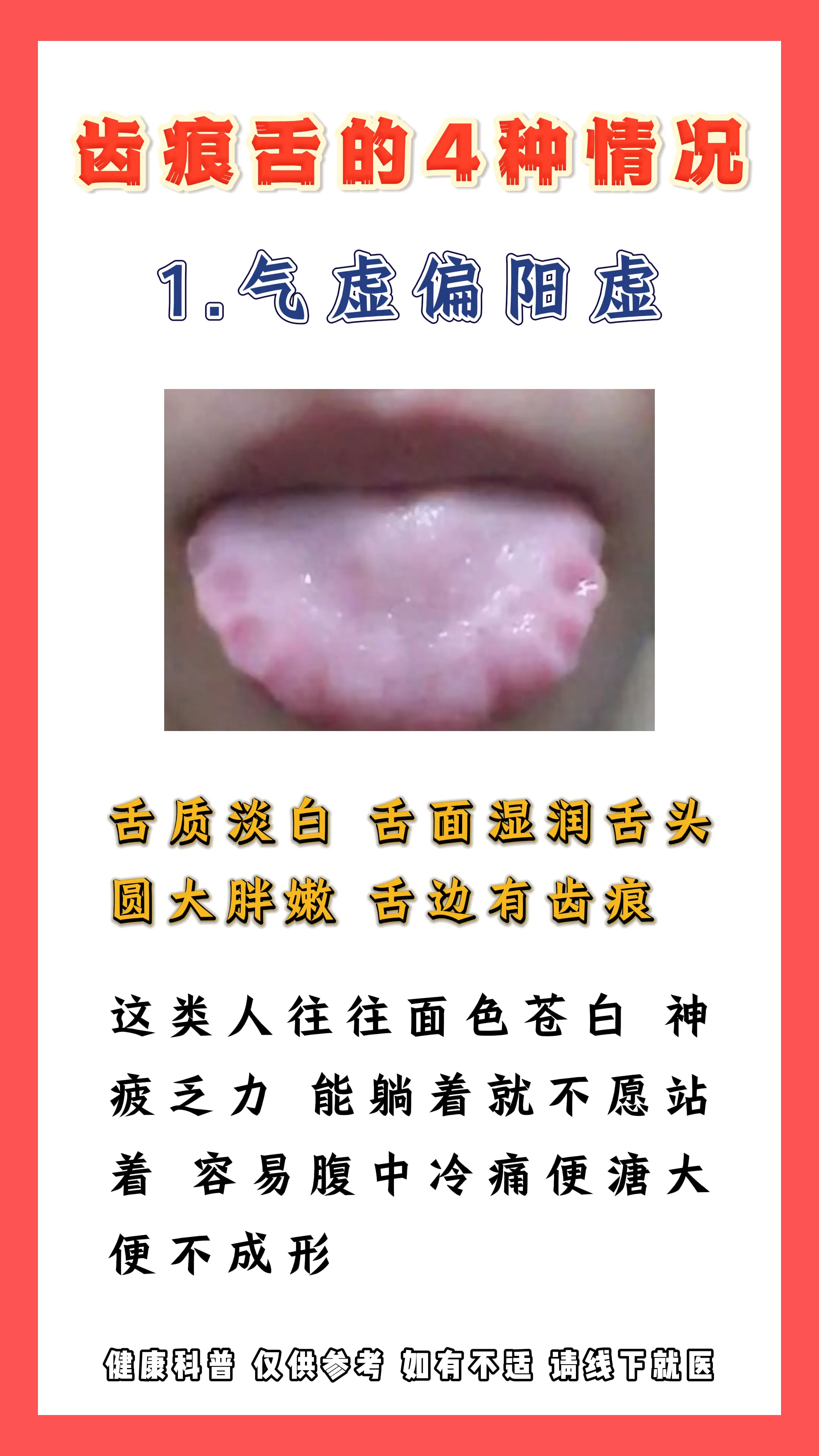 齿痕舌的4种情况，看看你是哪一种。