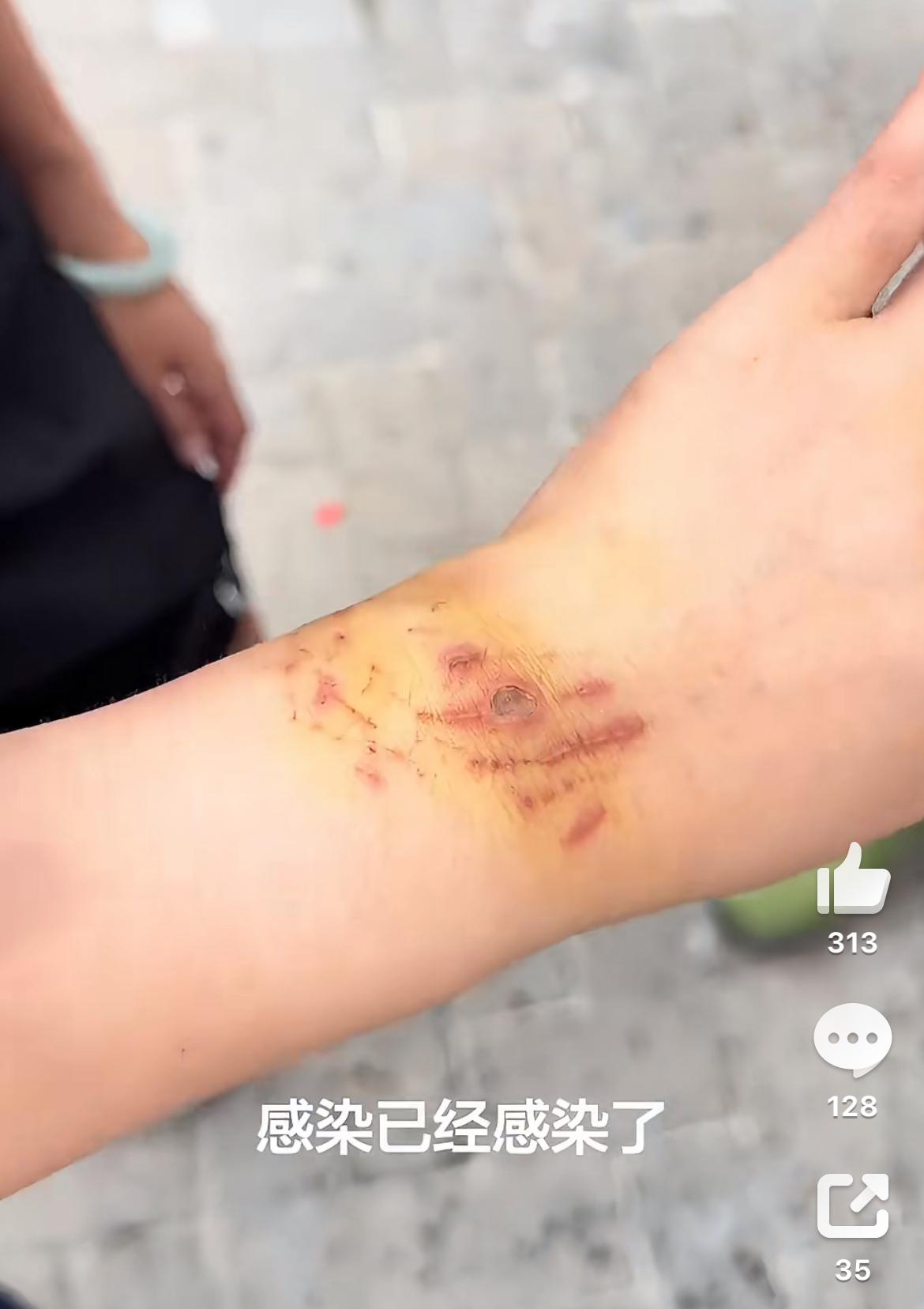 小仙女来大姨妈了却坚持下海游玩，和鲨鱼合影手臂被咬了，因为鲨鱼闻到血腥味。这是不