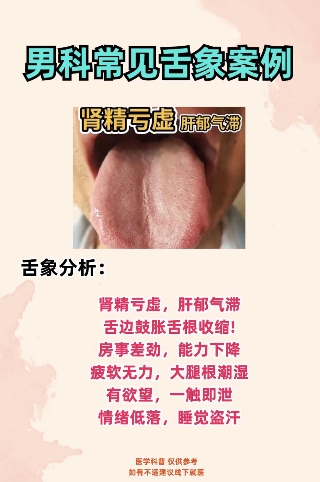 男科不好，常出现的几种舌象，看看你是哪一种？#健康##中医##舌诊##肾虚#
