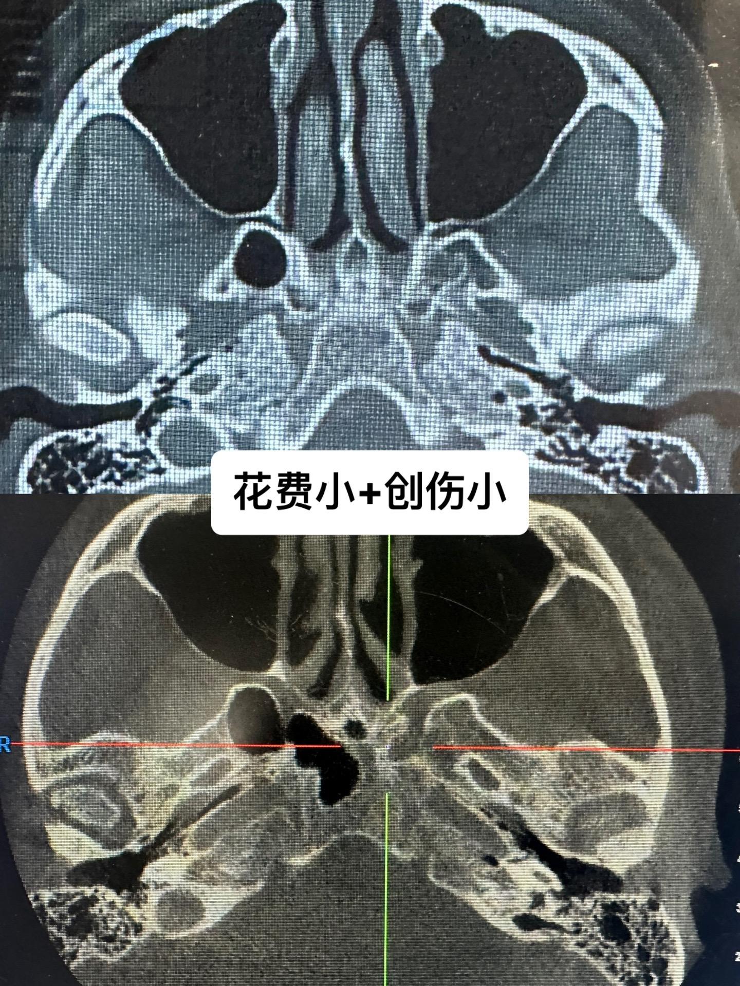 美女五天前受伤致左颧弓骨折，去了几个地方都是面部切口+几万费用。 昨天...
