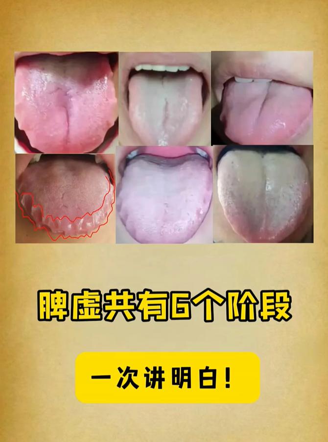 脾胃亏虚六层次，看舌头就能分辨清楚