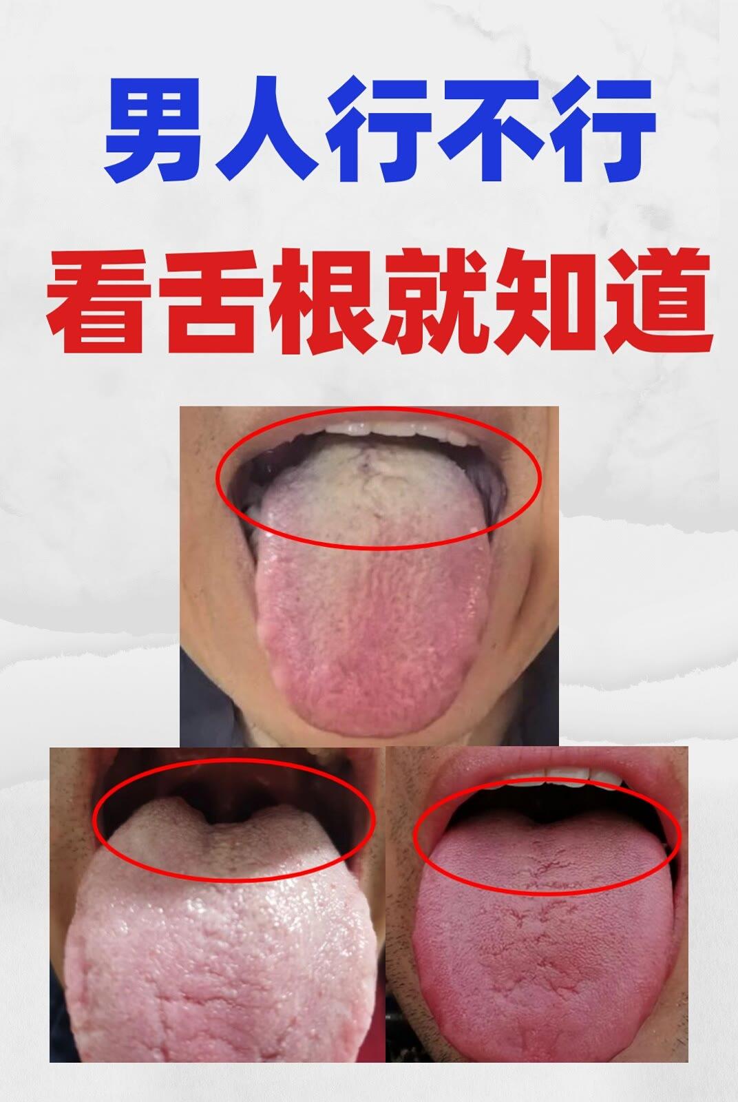 遇上这样的舌根，十有八九，房事上都会受影响
大家一定要先分辨清楚，再去用药，避免
