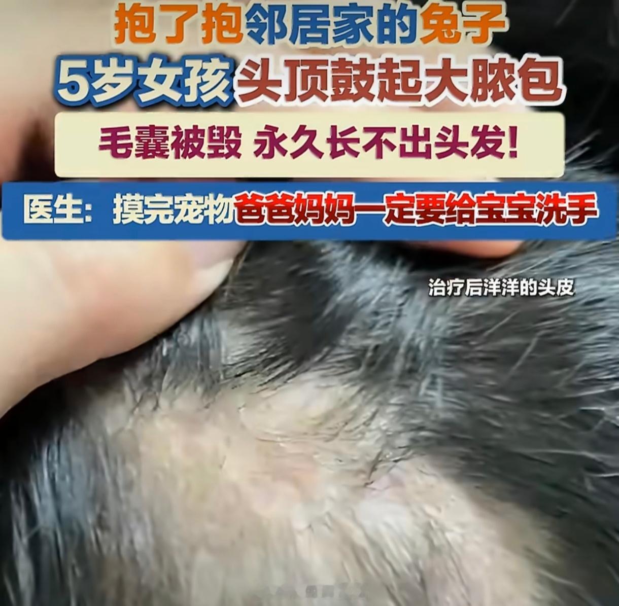 5岁女孩抱完兔子永久性脱发宁波5岁女童因抱兔子感染脓癣永久性脱发，揭开"隐形宠物