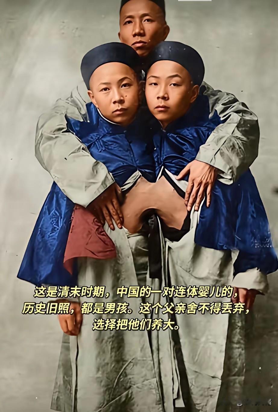 真是没有想到，原来在清末的时候，就有连体婴儿，在当时的医疗条件下，能把孩子拉扯这