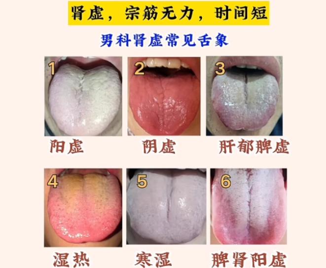 肾好不好，看舌头就知道了！你发我看，帮你分析男科问题！

应粉丝的要求，每天抽时