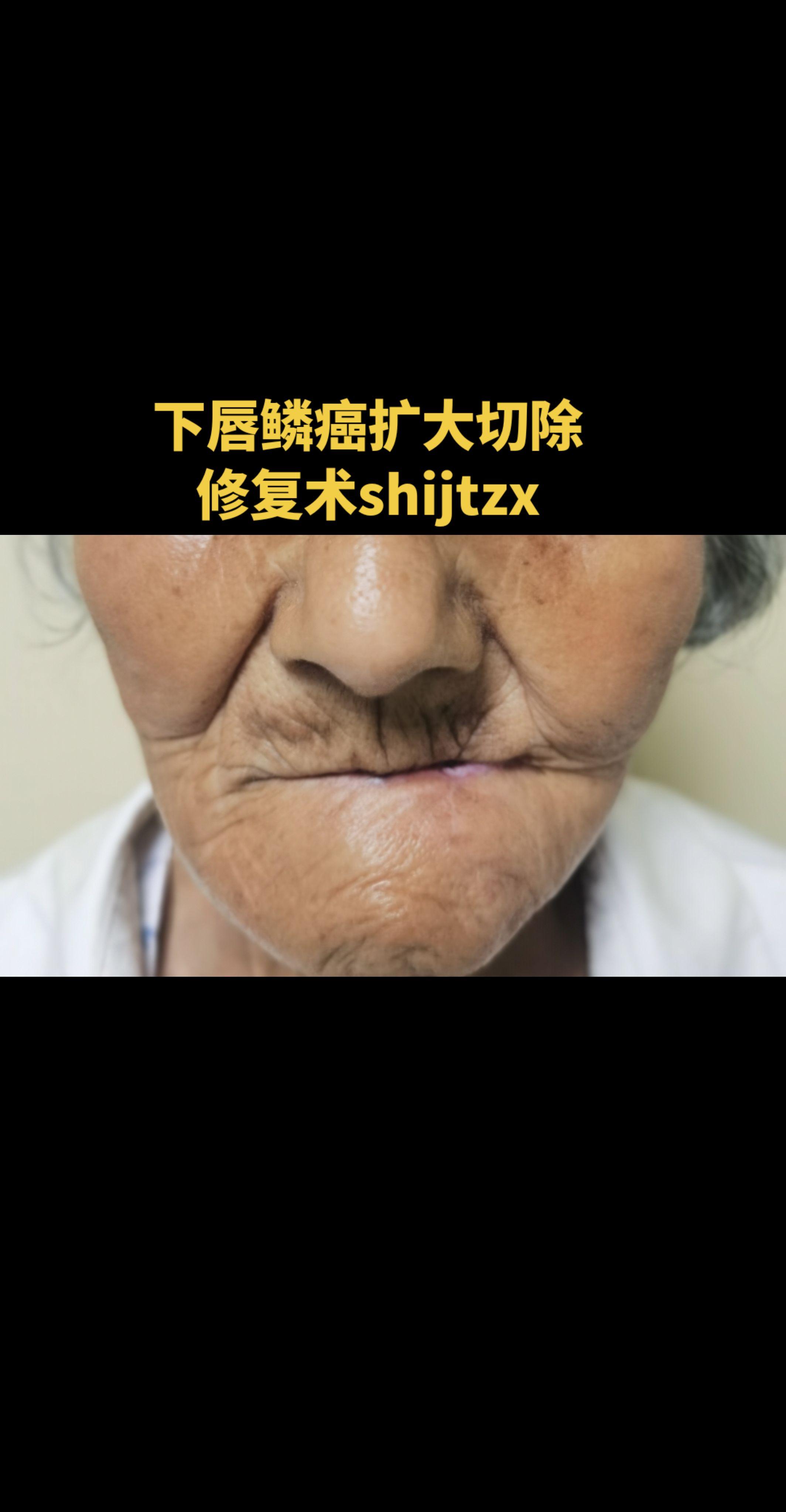 下唇鳞癌。下唇鳞癌扩大切除修复重建＋口角开大术，术后4月复诊。