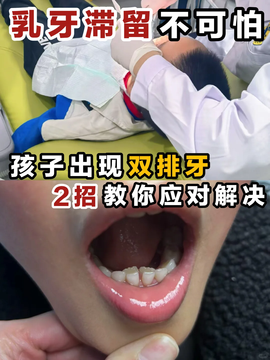 乳牙滞留不要怕！2招教你如何解决！