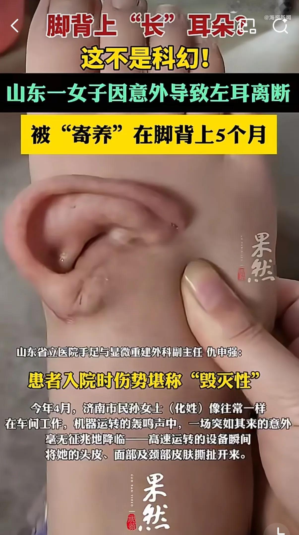 12小时手术，耳朵“住”脚背5个月，成功移植回原位！这是一位发生严重工作事故的女