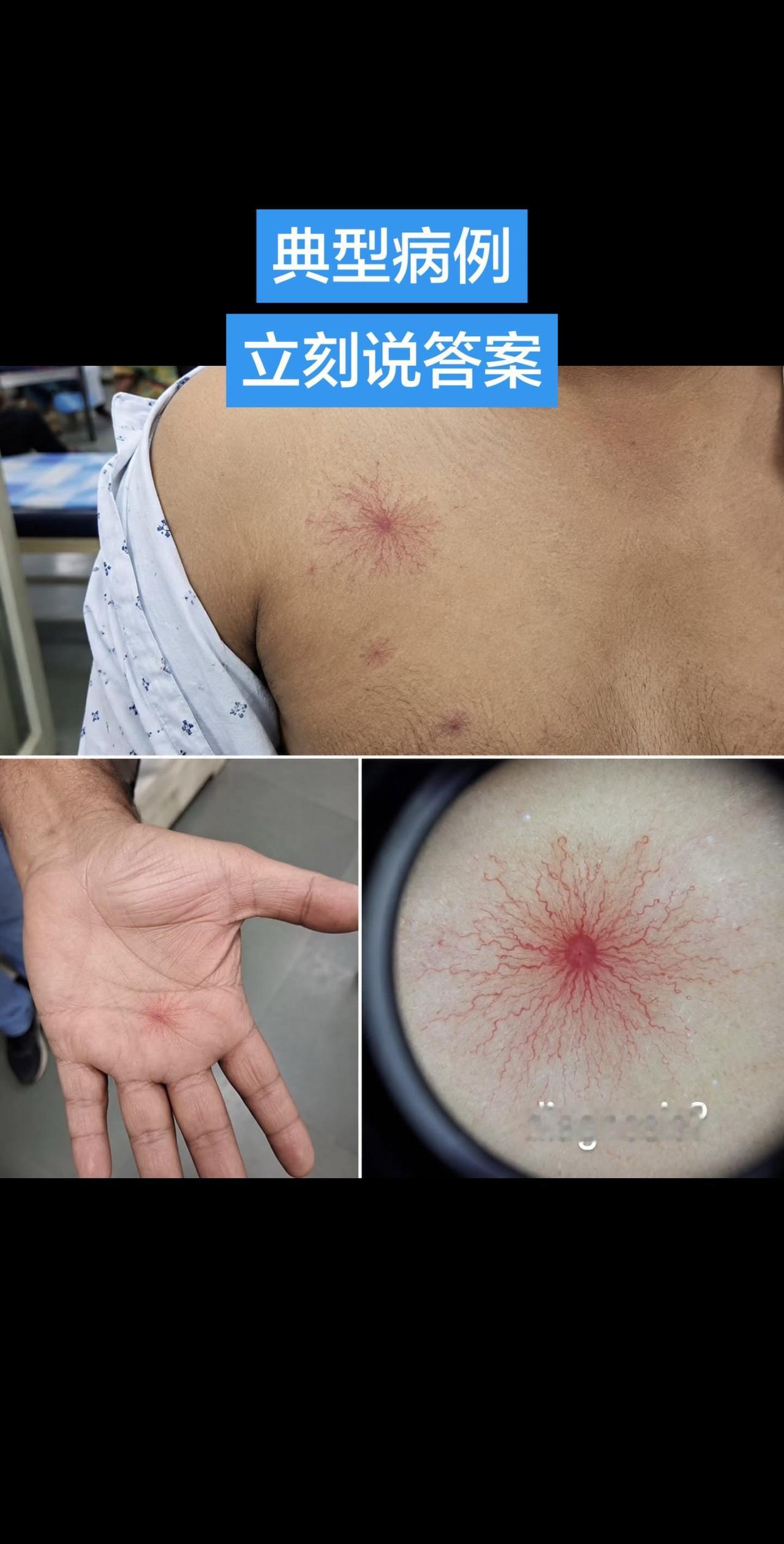 皮肤病变是什么？太典型了！学医的秒懂！患者，35岁，上胸及手掌多发无症状、持续性