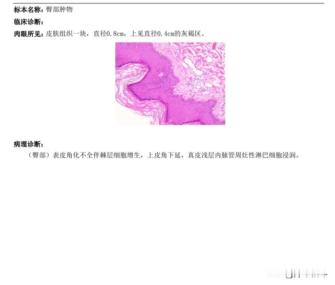 2024年11月份，市医院的活检报告出炉，确诊为“汗孔角化症”。我拿着检查结果到