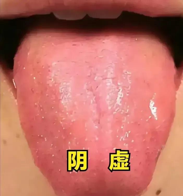 小孩大便像羊粪粒——脾胃阴虚
            辩证：但脾胃阴虚，体内阴液