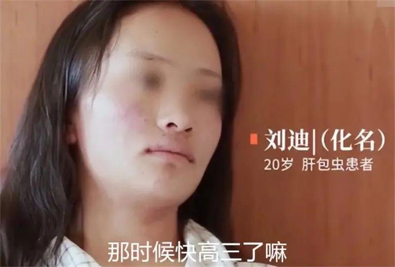 “已经虫癌晚期了。”在2019年，有个20岁的年轻女孩得了这种怪病。医生动手术时