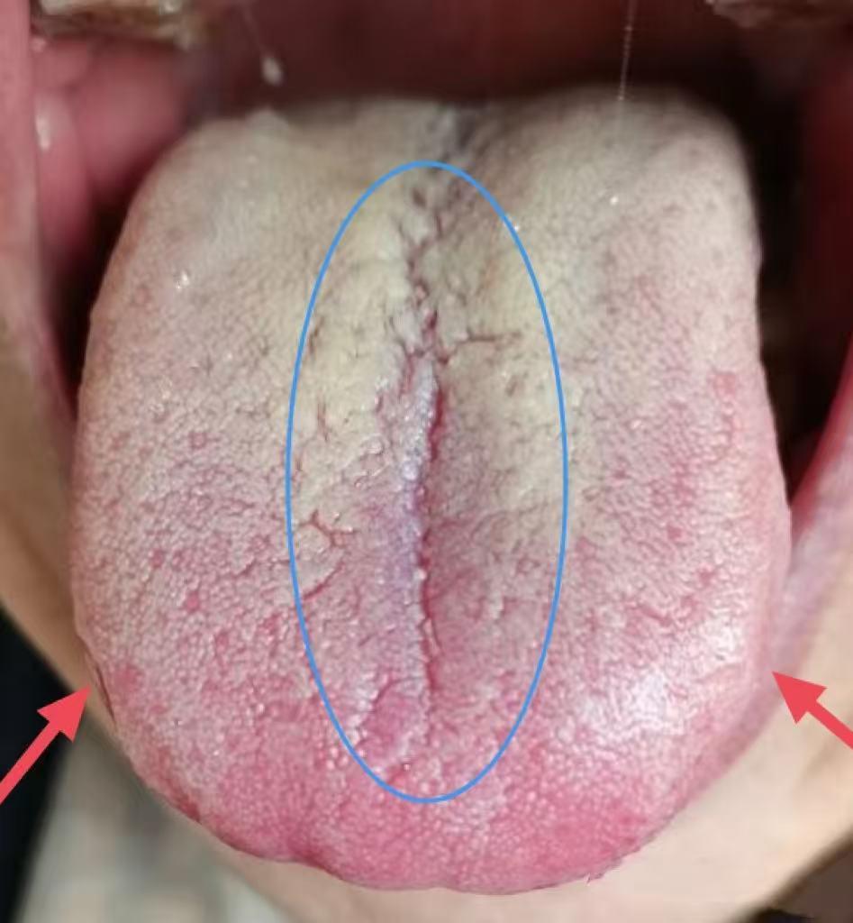 裂纹舌别乱调！忌健脾清火，滋阴才是关键，10天黄金搭配断根不反复！

很多人一看