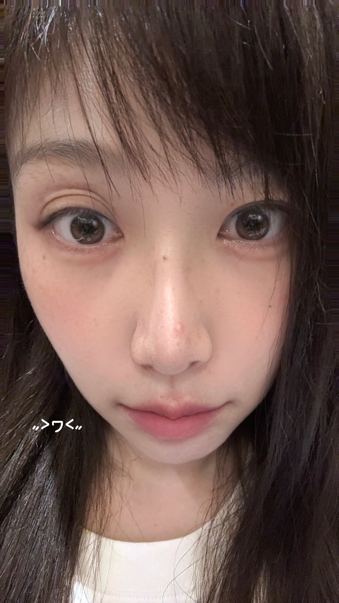 鼻子上长了个大痘子，我都好多年没长过痘儿了，包括青春期我也不长痘，长雀斑的人一般