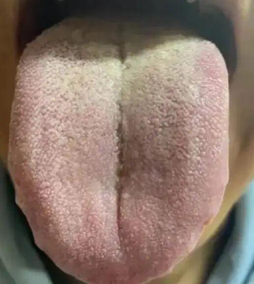 警惕舌边鼓胀、舌苔发黄及裂纹！
患者反映，之前已察觉舌苔呈现黄色，并尝试使用清热