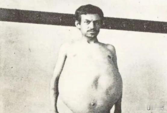 “他是被屎憋死的。”1940年，美国人约翰由于便秘，三年没排泄，不幸去世，医生检