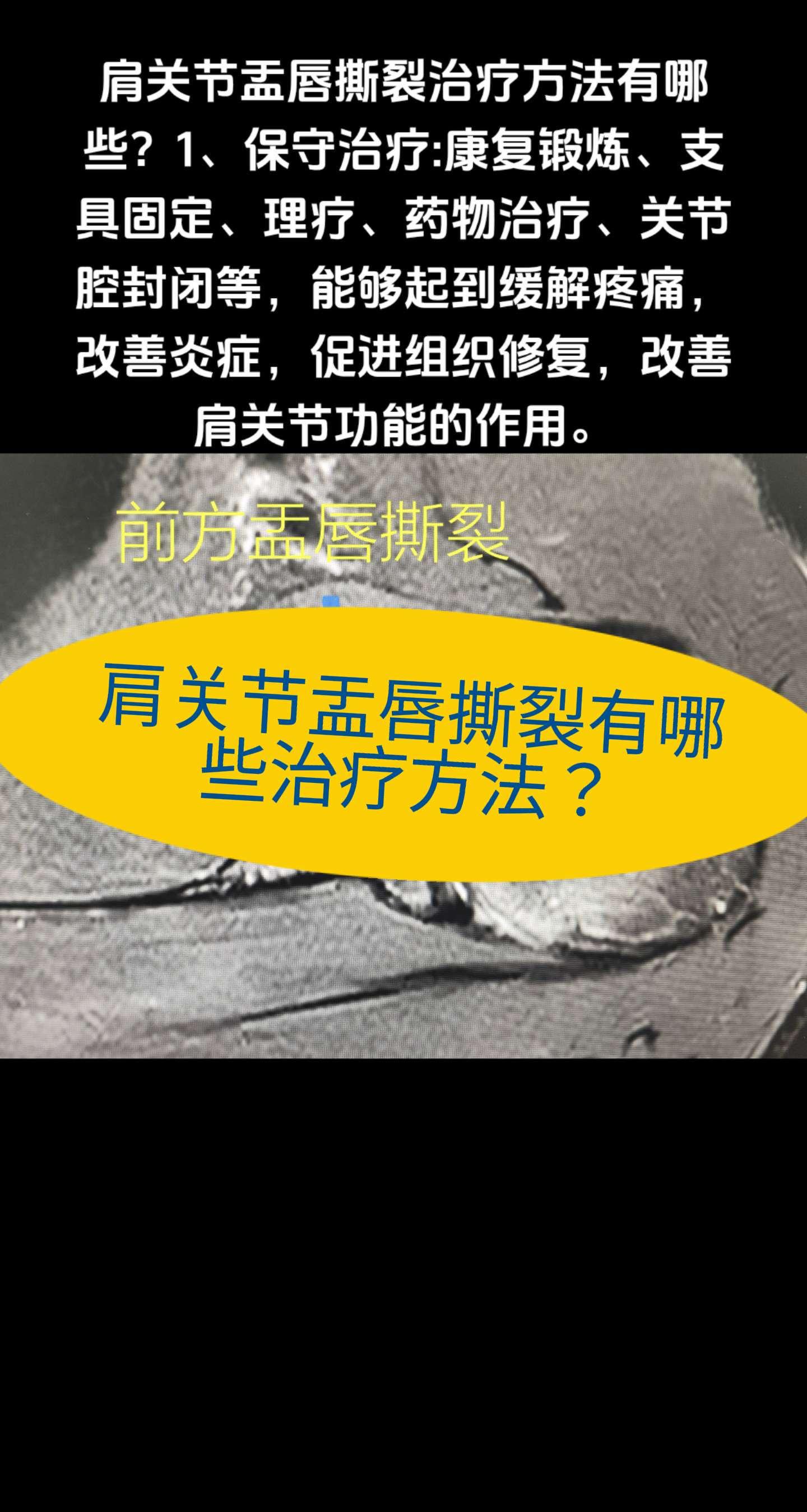 肩关节盂唇撕裂有哪些治疗方法？