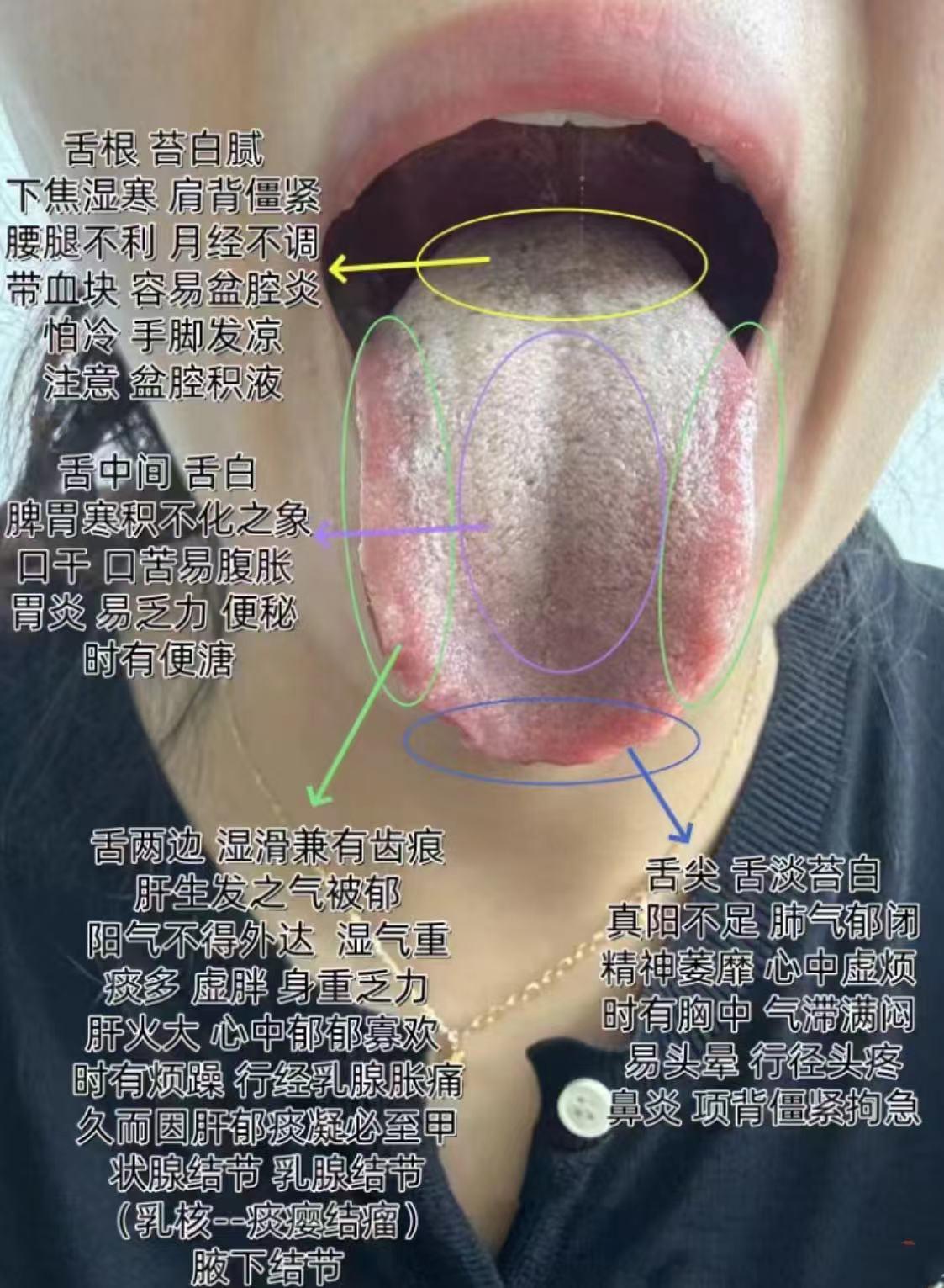 一个舌头究竟能看出，多少健康隐患，这个就是案例
刚刚遇到的病友，舌根舌苔厚腻，下